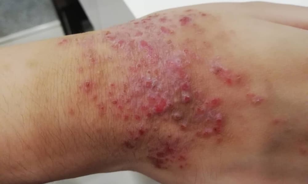 Moringa and Eczema Set 37 | Natpurity - Moringa Health Supplements & Skincare Malaysia